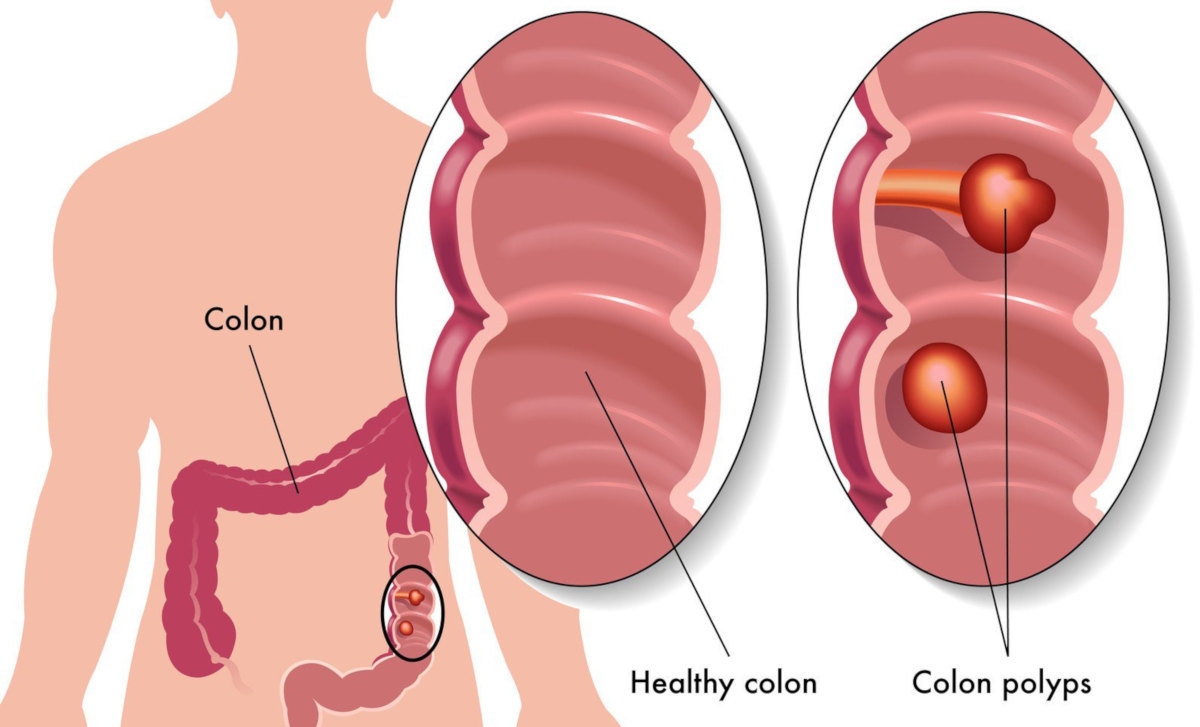Colon polyps - Hình ảnh minh họa